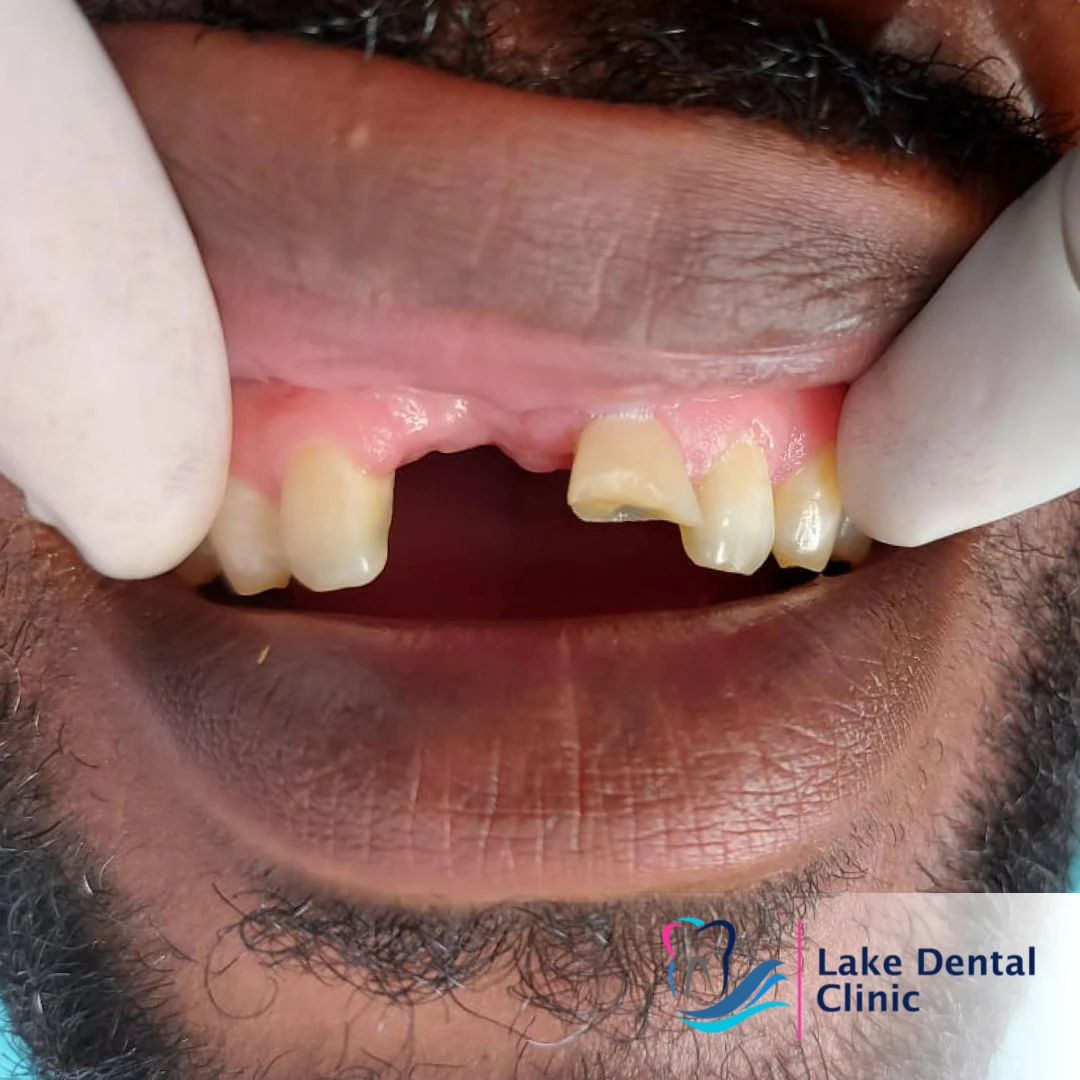 dentures, bridges and implants teeth replacement for missing teeth