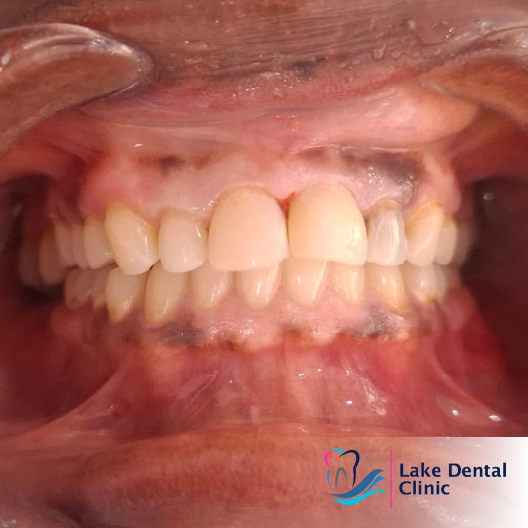 tooth filling for cavities