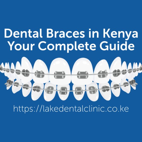 Dental braces in Kenya; your complete guide