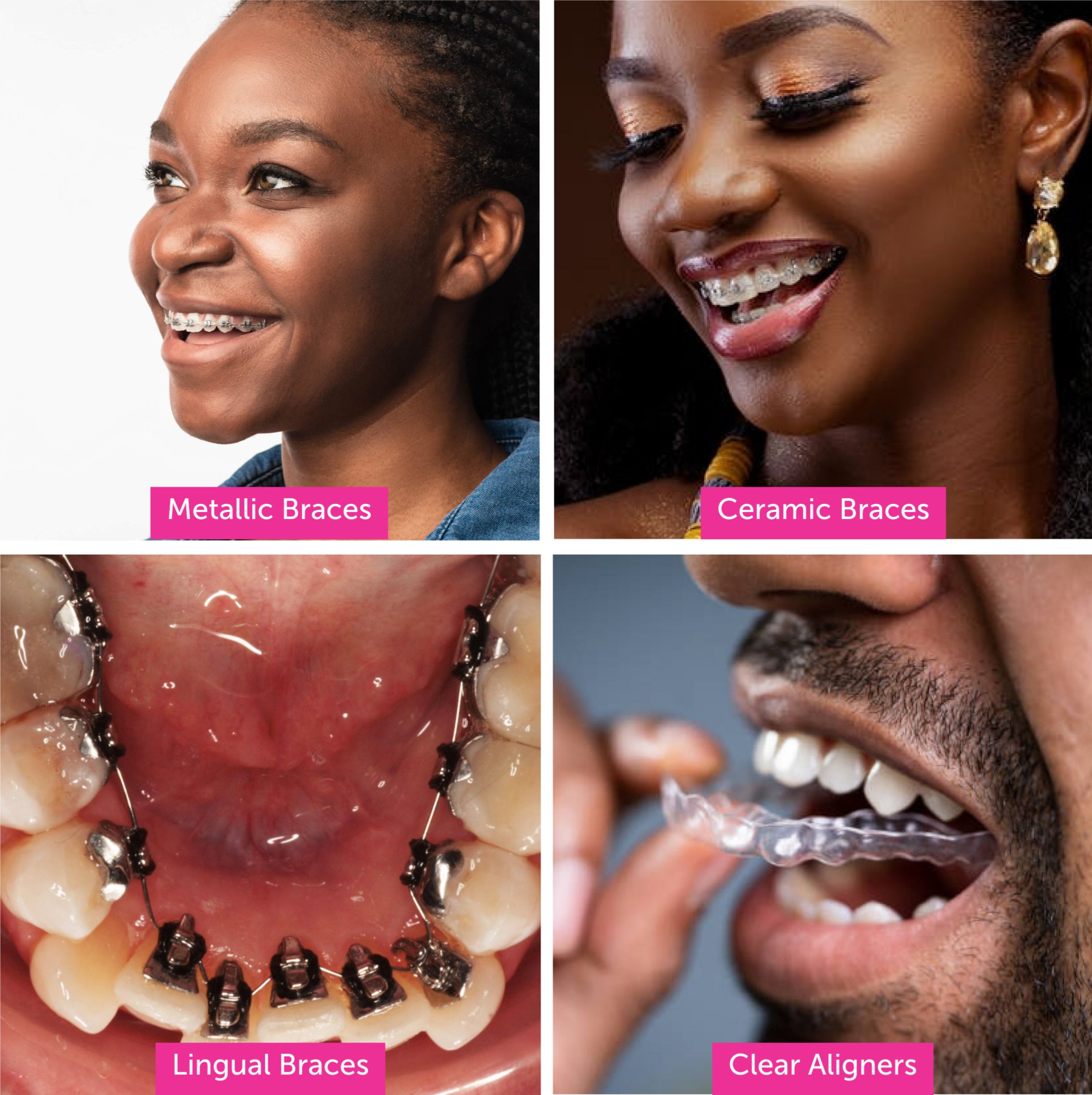 Types of Dental Braces in Kenya