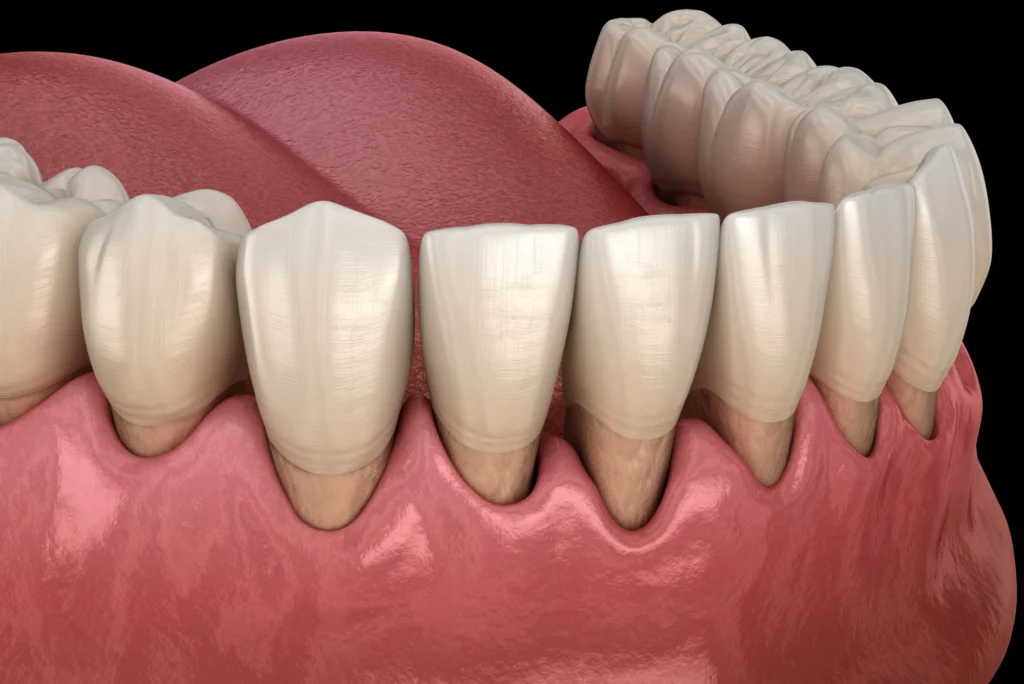 bleeding gums treatment