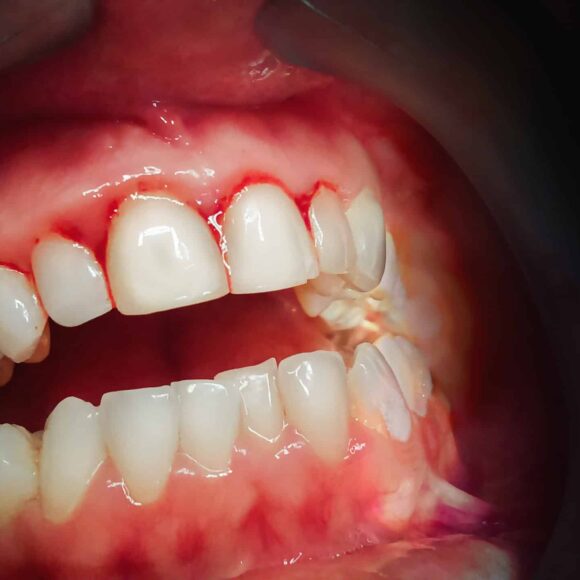 5 warning signs your gums are crying for help (and what to do about it)