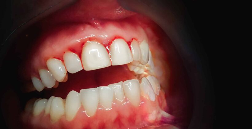 5 warning signs your gums are crying for help (and what to do about it)