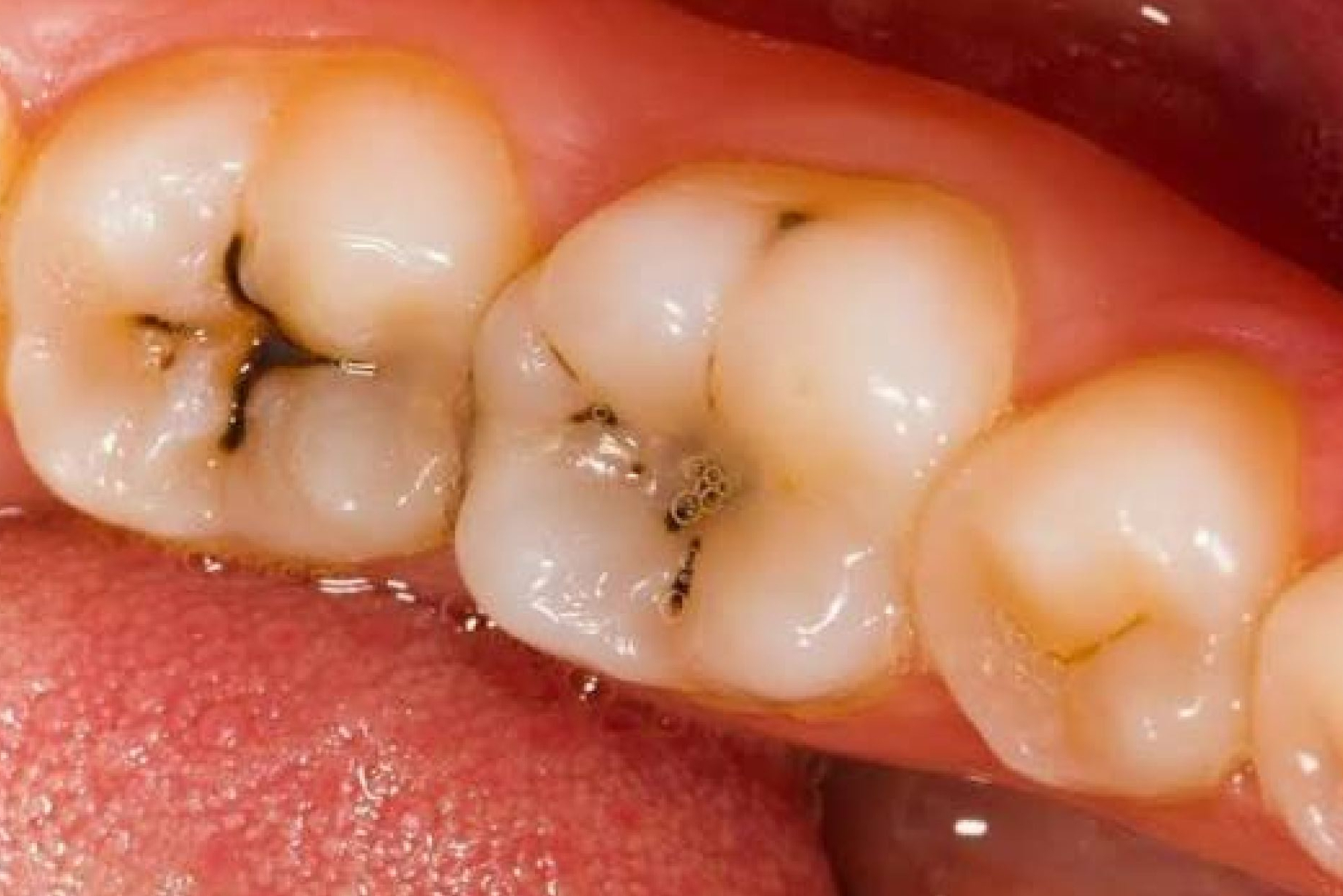 tooth decay deserves a filling